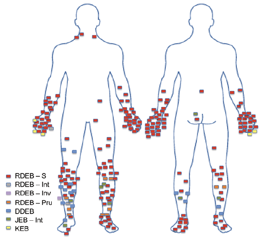 Distribution of SCCs in patients with DEB